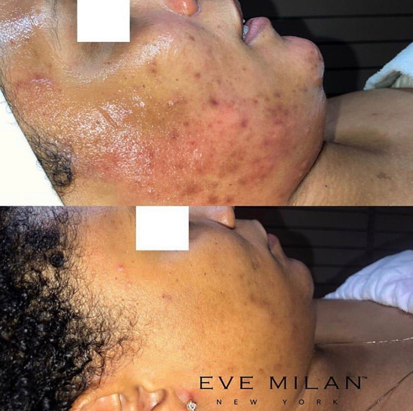 Post Inflammatory Hyperpigmentation (PIH) & How To Treat It